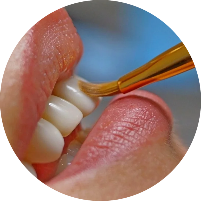 Баннер <span class="wow fadeTextBg animContrastTextBg">Художественная реставрация зубов в&nbsp;Уфе</span>&nbsp;&mdash; эстетическое восстановление стенок зубов композитными материалами